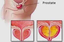 prostatu