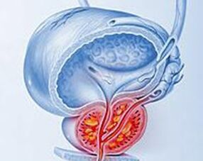 prostataren hantura prostatitisarekin