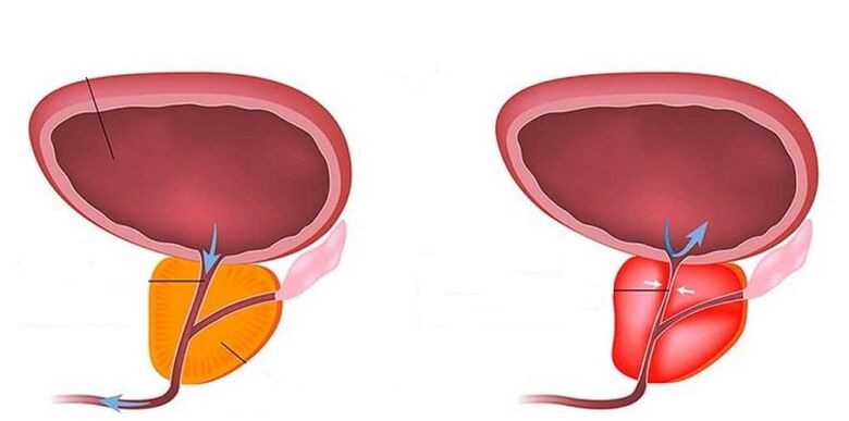 Prostatitis osasuntsua eta hantura
