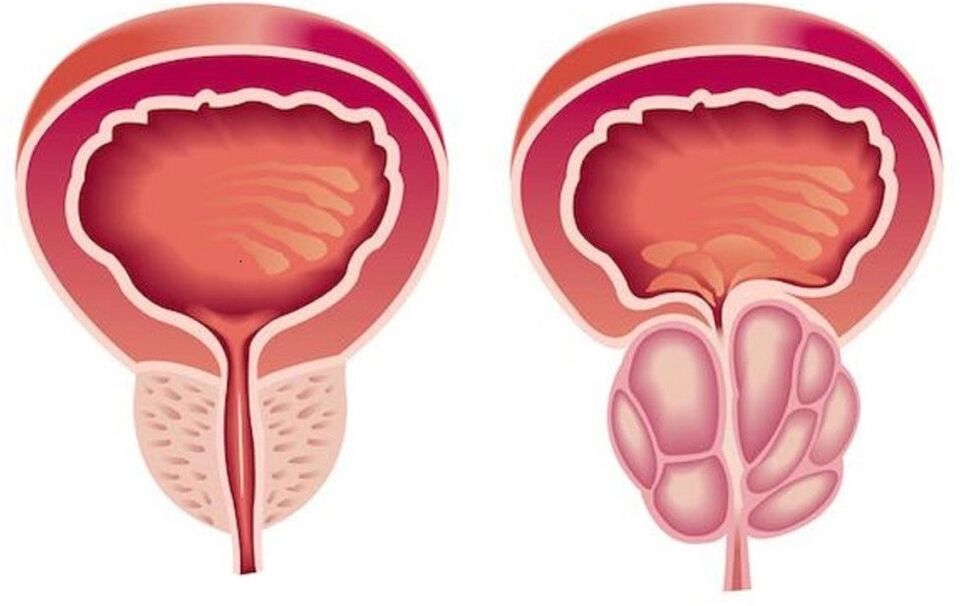 prostatitisarekin prostata osasuntsu eta hanturatuta