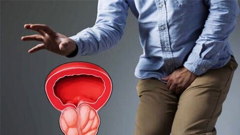 prostatitisaren sintomak gizon batengan